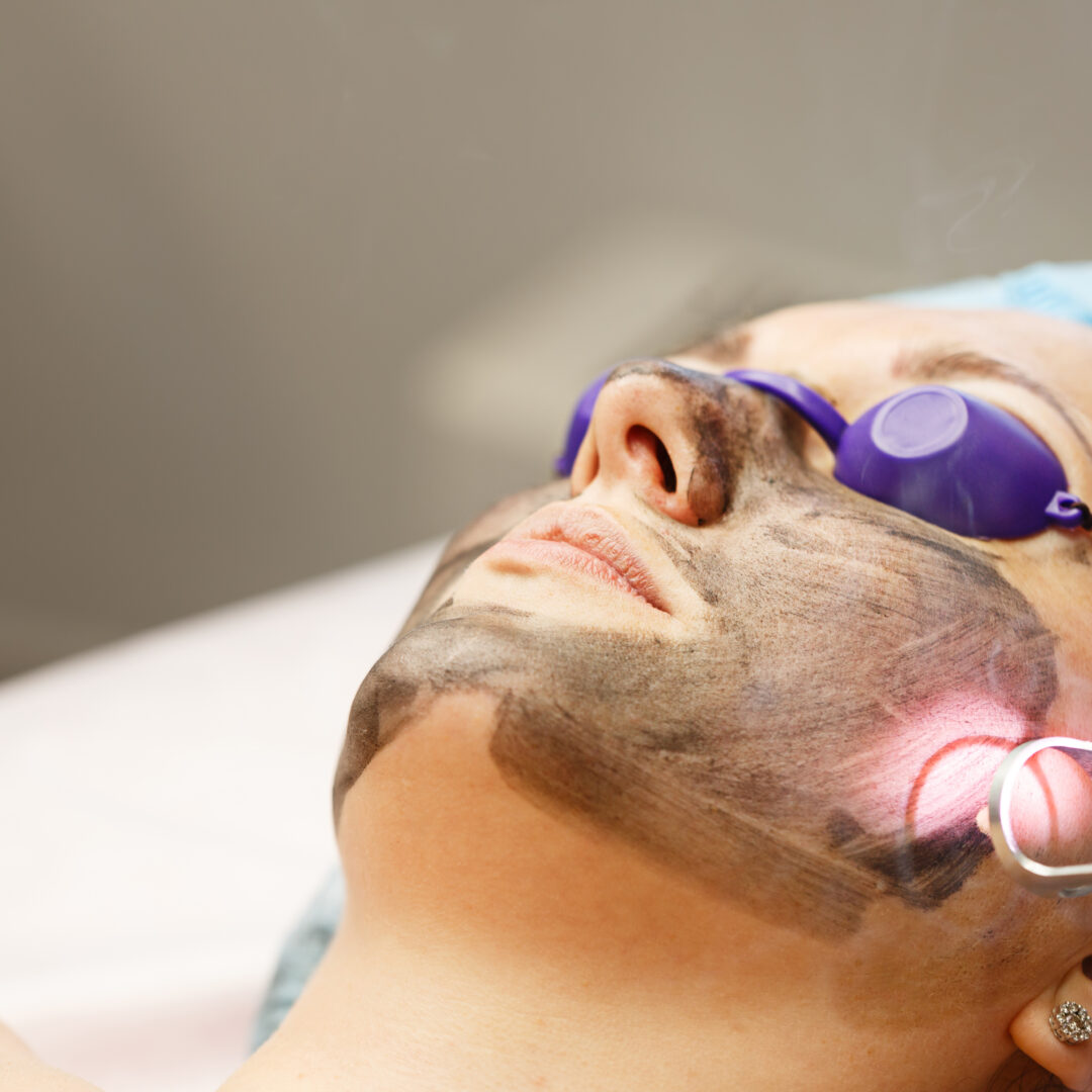 Carbon face peeling. Laser pulses clean the skin of the face. Hardware cosmetology. The process of photothermolysis, warming the skin. Facial skin rejuvenation.